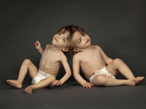 The Twins Who Share A Brain