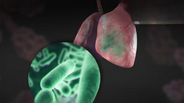 Tuberculosis (SciCast #436)